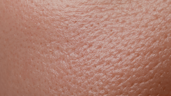 Piel Grasa